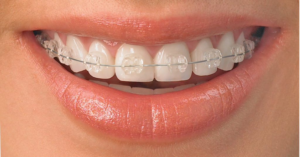 radiance_clear_braces_leeds_orthodontists_clarendon_dental_spa