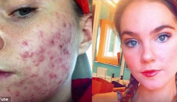 Twin-Sisters-Cured-Their-Acne-in-Just-1-Month-1 (1)