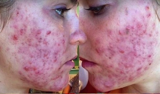 Twin-Sisters-Cured-Their-Acne-in-Just-1-Month-1