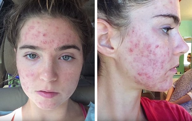 Twin-Sisters-Cured-Their-Acne-in-Just-1-Month-2