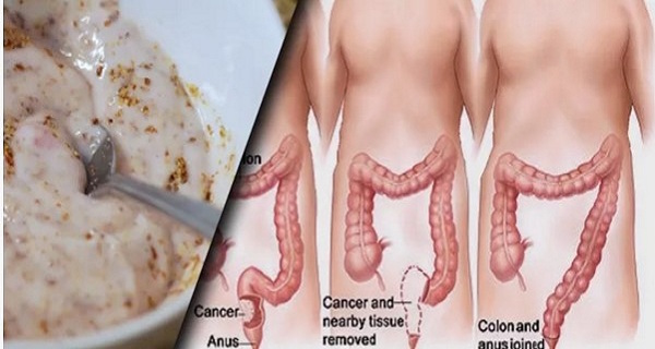 these-two-ingredients-remove-pounds-of-toxins-from-your-intestines