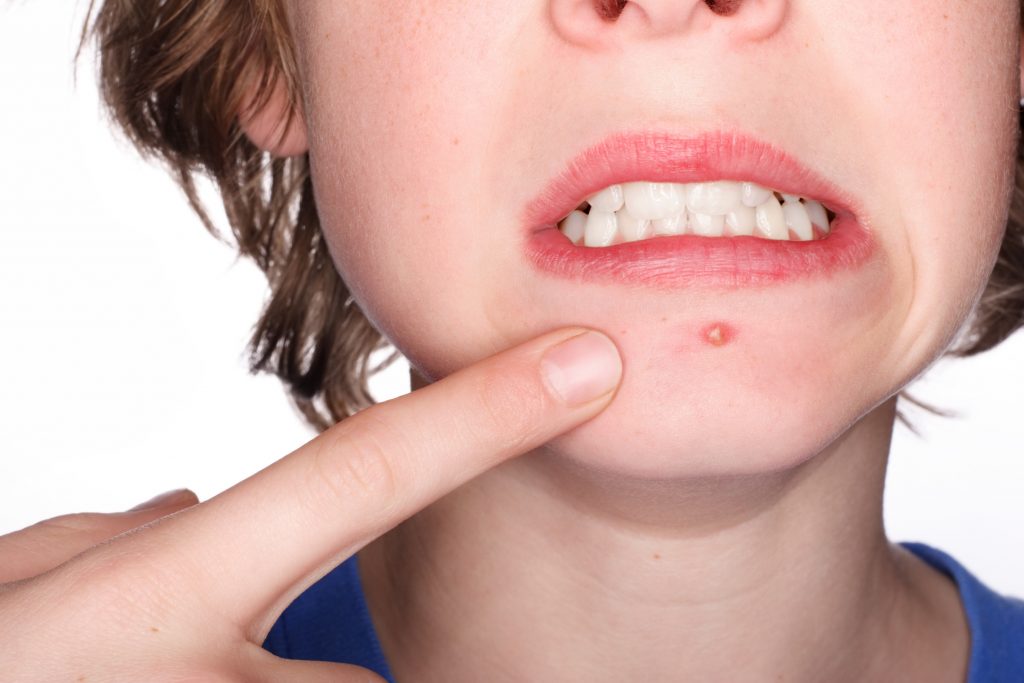 An adolescent boy pointing at a pimple on his chin and grimacing