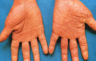 dry-skin-in-palms