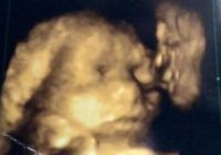 Mamma sava bērniņa ultraskaņā ierauga kaut ko neticamu un biedējošu