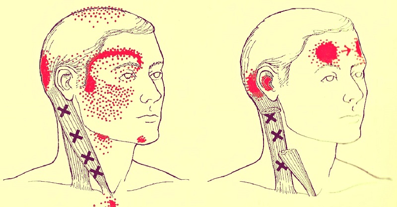 galvas-sapju-migrenu-rasanas-iemesli Kā apturēt galvassāpes