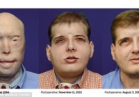 VIŅAM veikta vissarežģitāka sejas transplantācijas operācija; rezultāts ir iespaidīgs