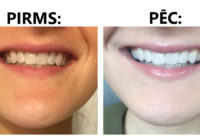 Skaistuma blogeri ir sajūsmā: Dabīga zobu balināšanas metode, kas patiešām strādā!