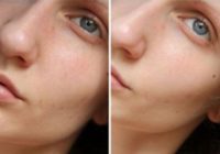 Ar vienas procedūras palīdzību veiciet dziļo sejas attīrīšanu