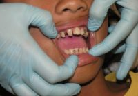 Zobu sāpes: Ātrākie veidi un tautas līdzekļi, kā atbrīvoties no zobu sāpēm